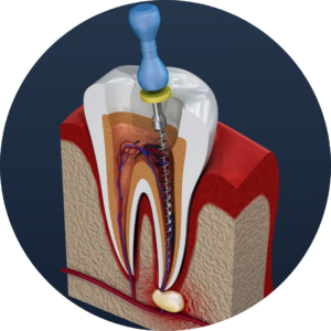 रूट कैनाल ट्रीटमेन्ट Root Canal Treatment