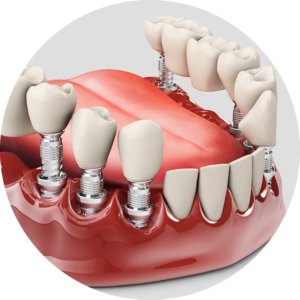 फिक्स बत्तीसी लगवाना Fixed Dental Denture