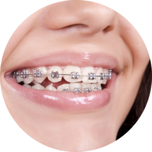 टेढ़े-मेढ़े दांतों का इलाज Orthodontic Treatment