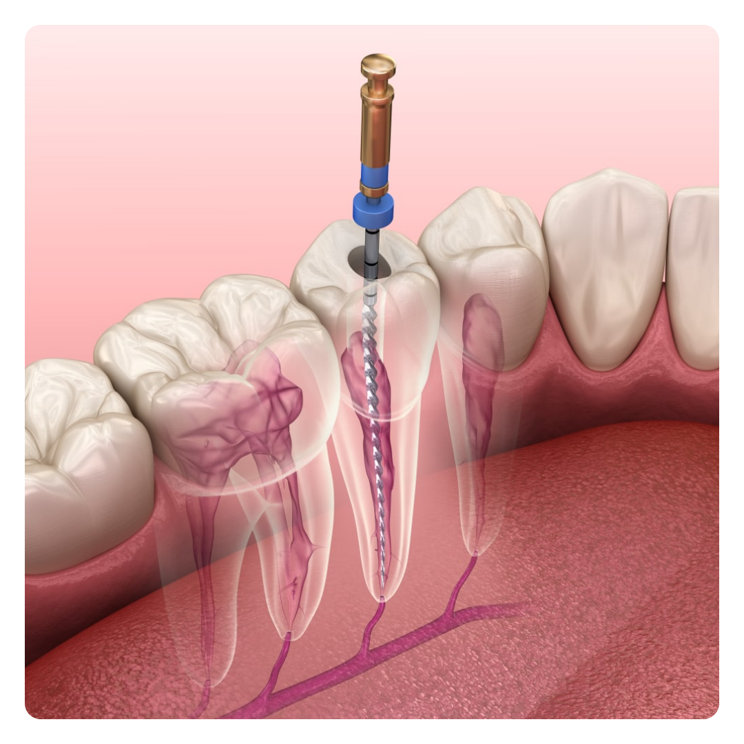 Root Canal Treatment