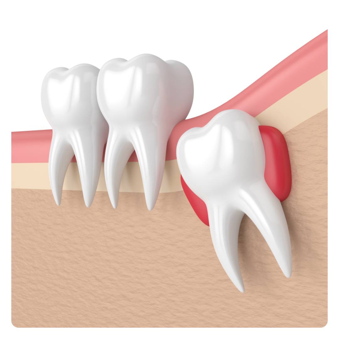 Wisdom Tooth Removal