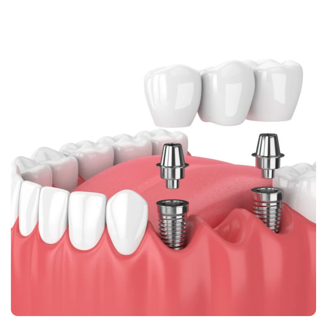 Tooth Implant (Dental Implants)