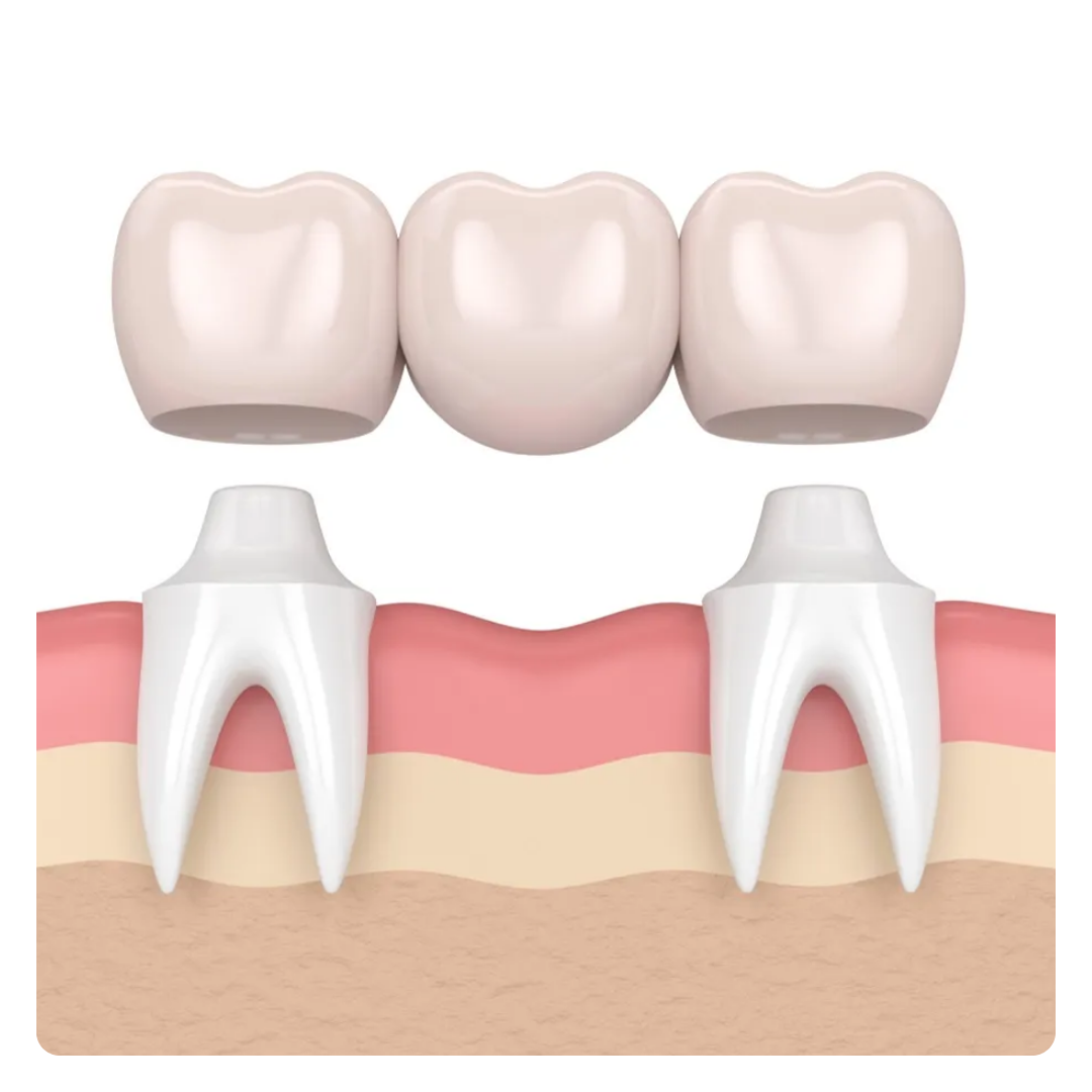 Dental Crown / Dental Bridge