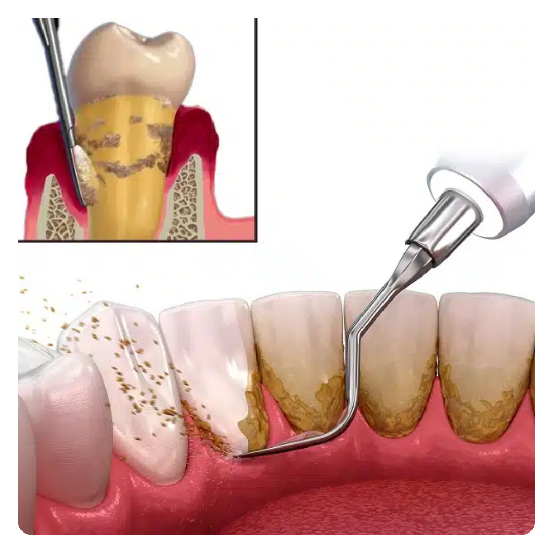 Dental Cleaning & Dental Scaling